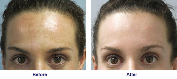 Intense Pulsed Light (IPL) Before and After Photo