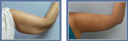 Before and After Photo - Arm Lift