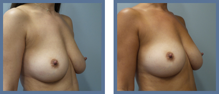 Fat Grafting Before and After Photo