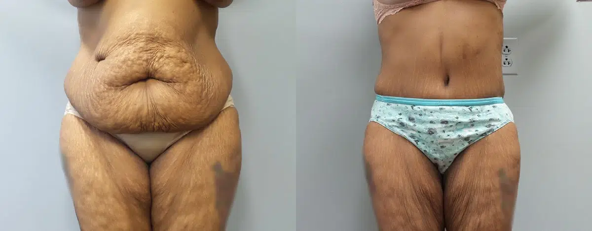 tummy tuck abdominoplasty before and after photo by main line institute of plastic surgery in wynnewood pa