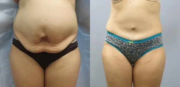 tummy tuck abdominoplasty before and after photo by main line institute of plastic surgery in wynnewood pa