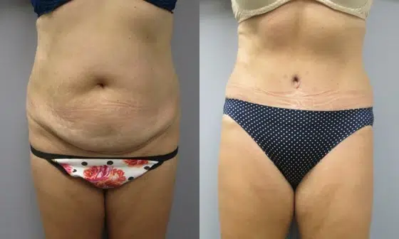 tummy tuck abdominoplasty before and after photo by main line institute of plastic surgery in wynnewood pa