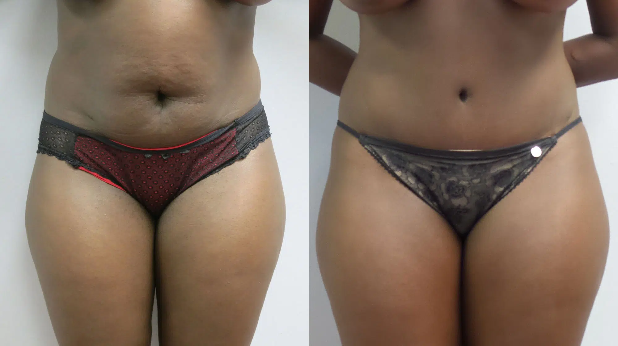 tummy tuck abdominoplasty before and after photo by main line institute of plastic surgery in wynnewood pa