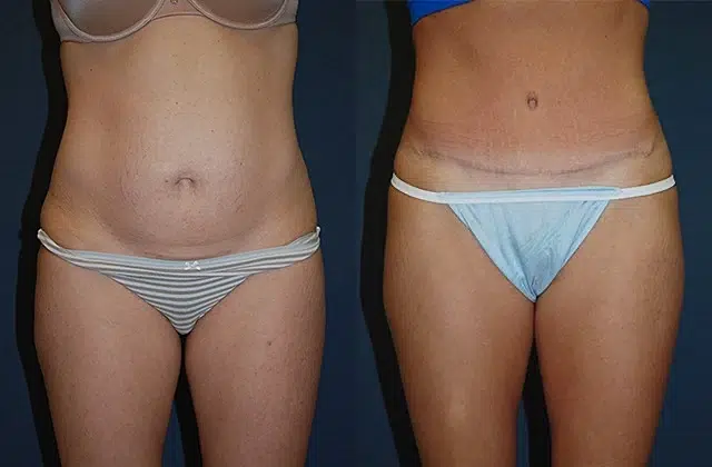 tummy tuck abdominoplasty before and after photo by main line institute of plastic surgery in wynnewood pa