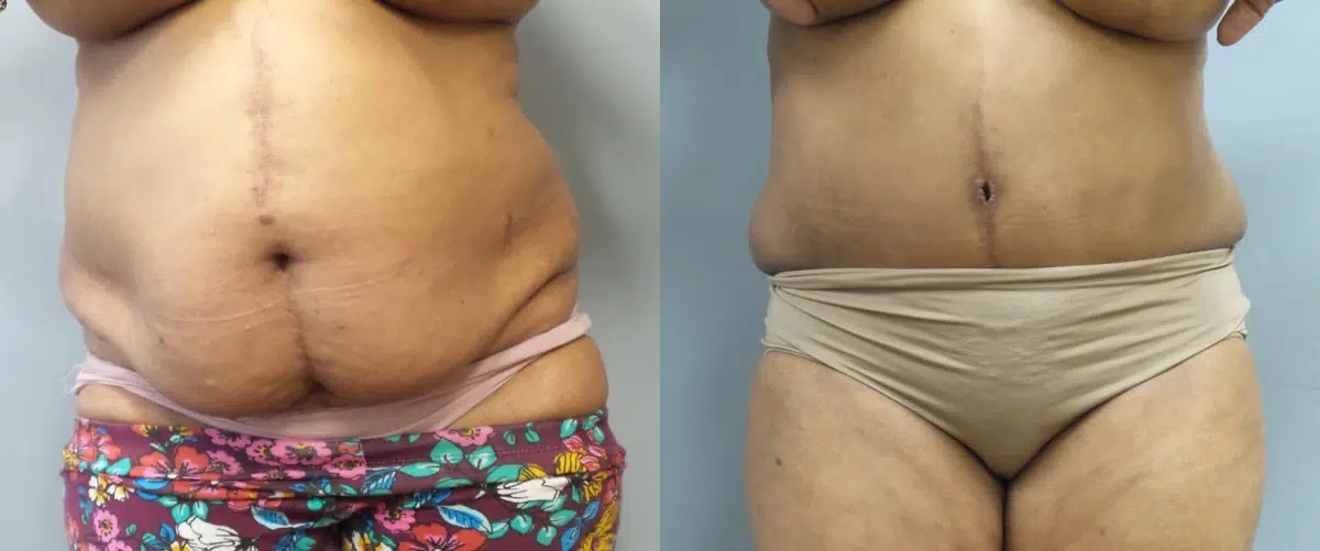 tummy tuck abdominoplasty before and after photo by main line institute of plastic surgery in wynnewood pa