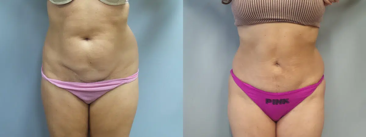 tummy tuck abdominoplasty before and after photo by main line institute of plastic surgery in wynnewood pa
