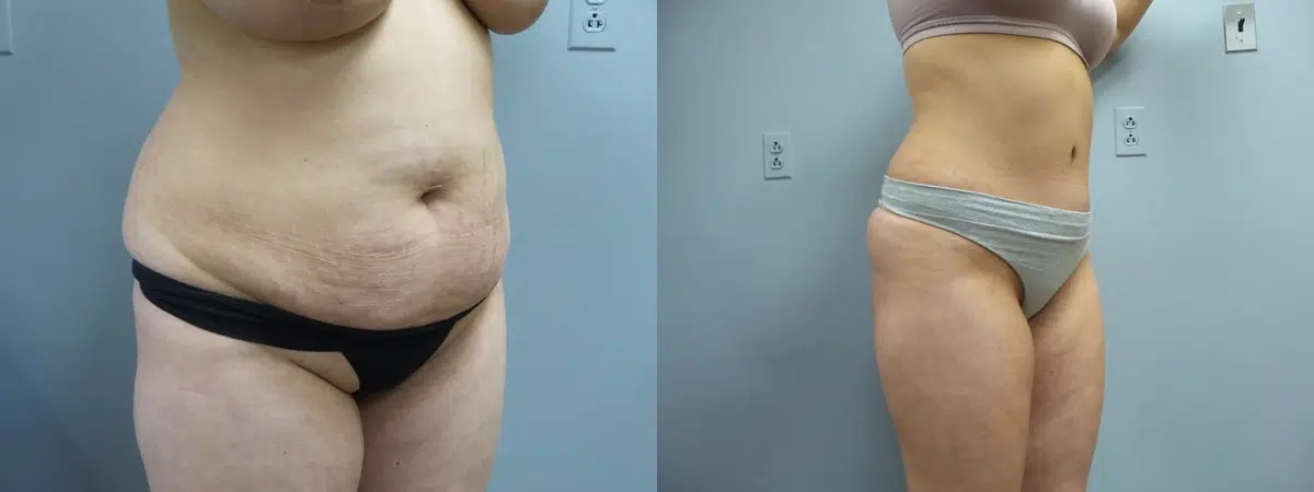 tummy tuck abdominoplasty before and after photo by main line institute of plastic surgery in wynnewood pa