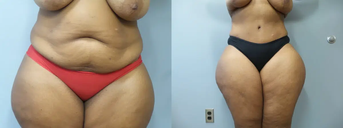 tummy tuck abdominoplasty before and after photo by main line institute of plastic surgery in wynnewood pa