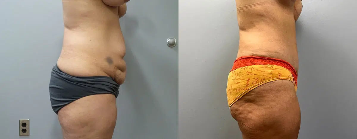 tummy tuck abdominoplasty before and after photo by main line institute of plastic surgery in wynnewood pa