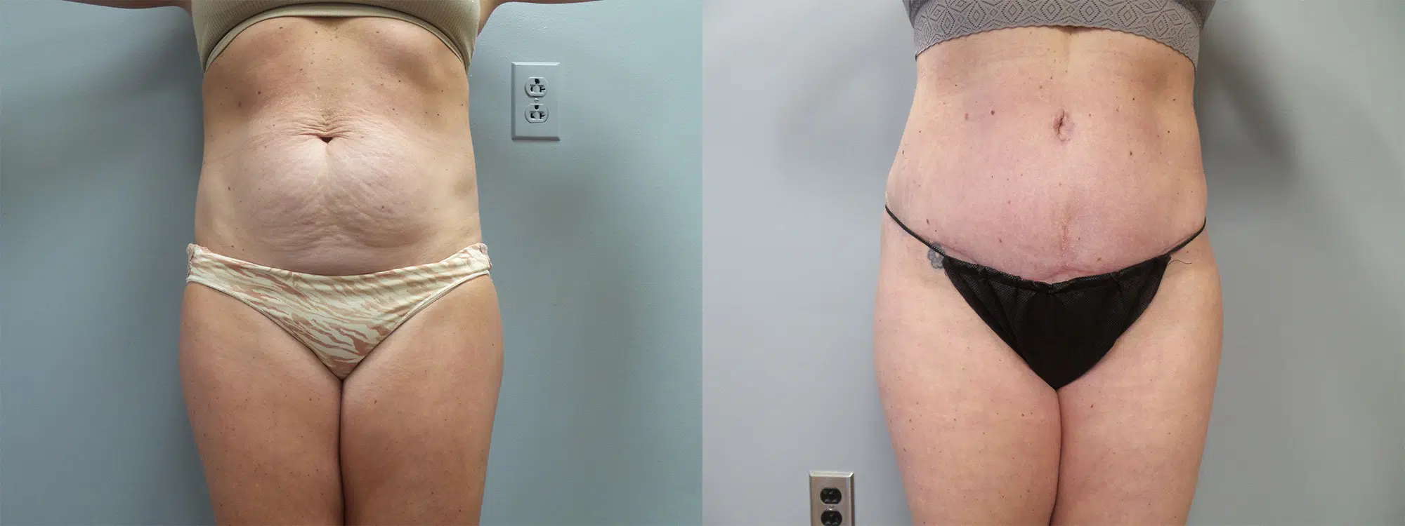 tummy tuck abdominoplasty before and after photo by main line institute of plastic surgery in wynnewood pa