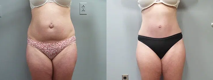 tummy tuck abdominoplasty before and after photo by main line institute of plastic surgery in wynnewood pa