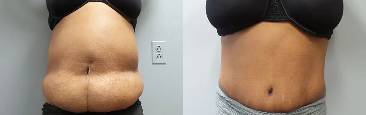 tummy tuck abdominoplasty before and after photo by main line institute of plastic surgery in wynnewood pa