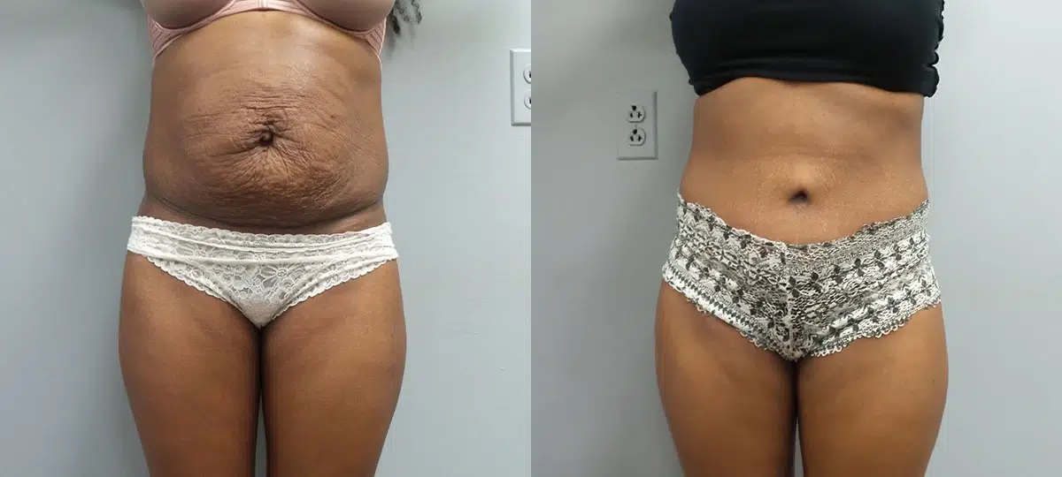tummy tuck abdominoplasty before and after photo by main line institute of plastic surgery in wynnewood pa