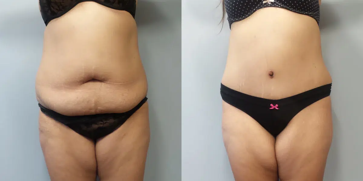 tummy tuck abdominoplasty before and after photo by main line institute of plastic surgery in wynnewood pa