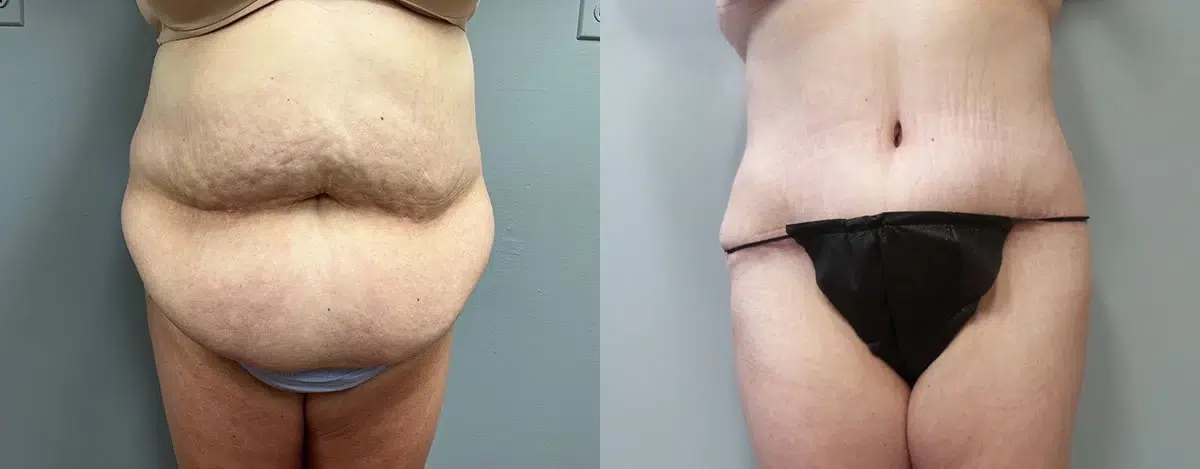tummy tuck abdominoplasty before and after photo by main line institute of plastic surgery in wynnewood pa