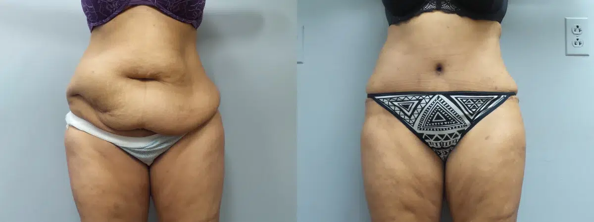 tummy tuck abdominoplasty before and after photo by main line institute of plastic surgery in wynnewood pa