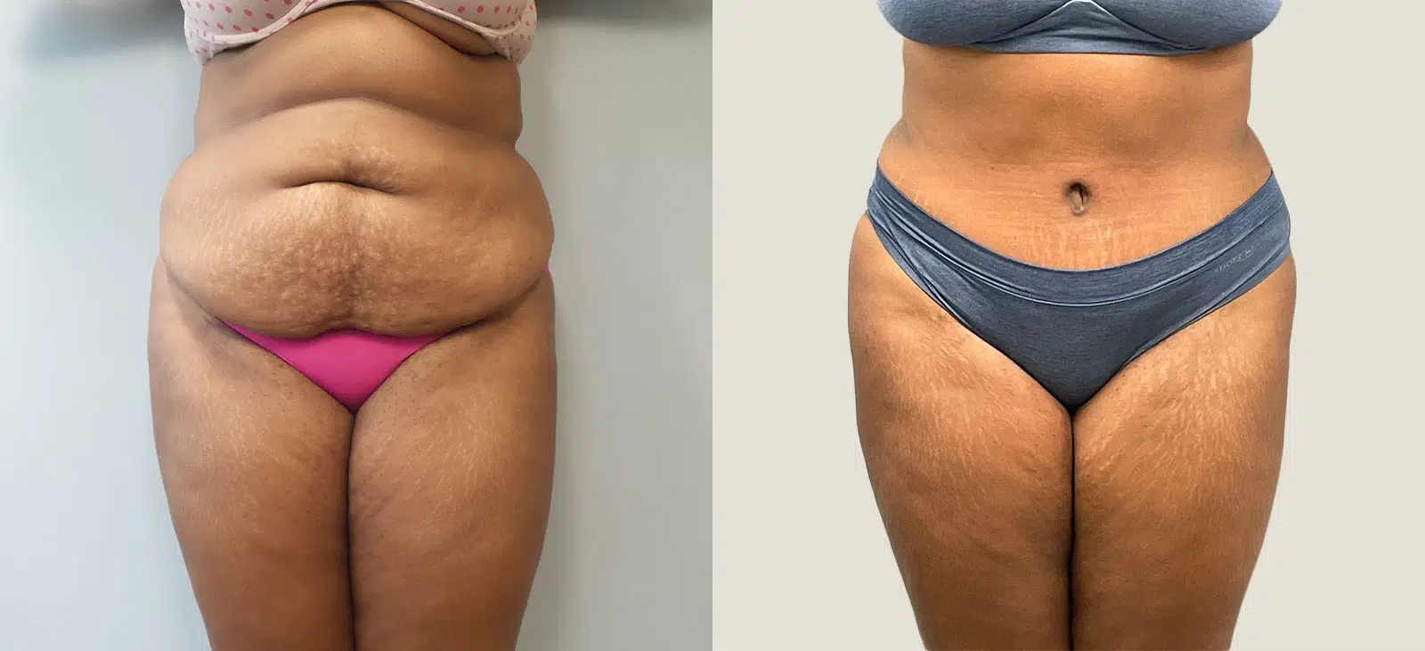 tummy tuck abdominoplasty before and after photo by main line institute of plastic surgery in wynnewood pa