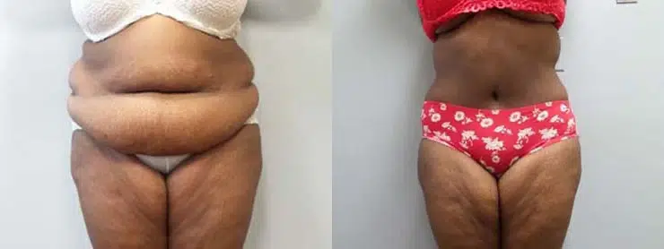 tummy tuck abdominoplasty before and after photo by main line institute of plastic surgery in wynnewood pa