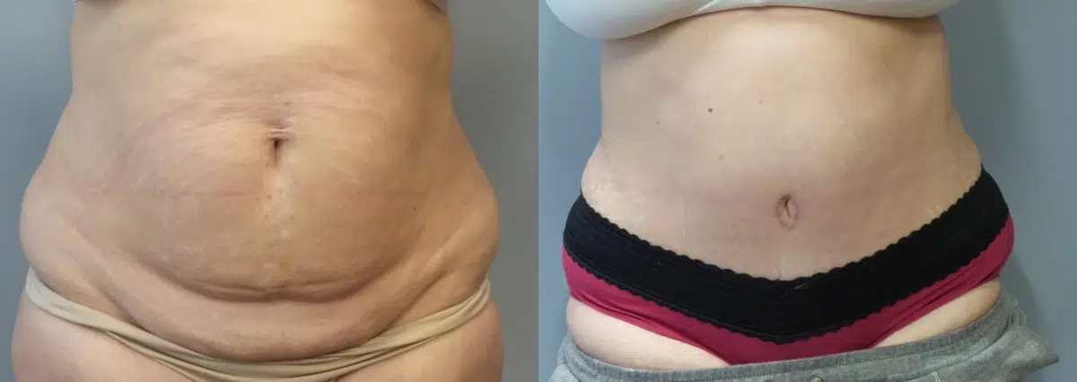 tummy tuck abdominoplasty before and after photo by main line institute of plastic surgery in wynnewood pa