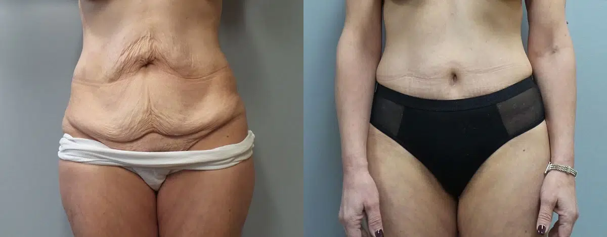 tummy tuck abdominoplasty before and after photo by main line institute of plastic surgery in wynnewood pa