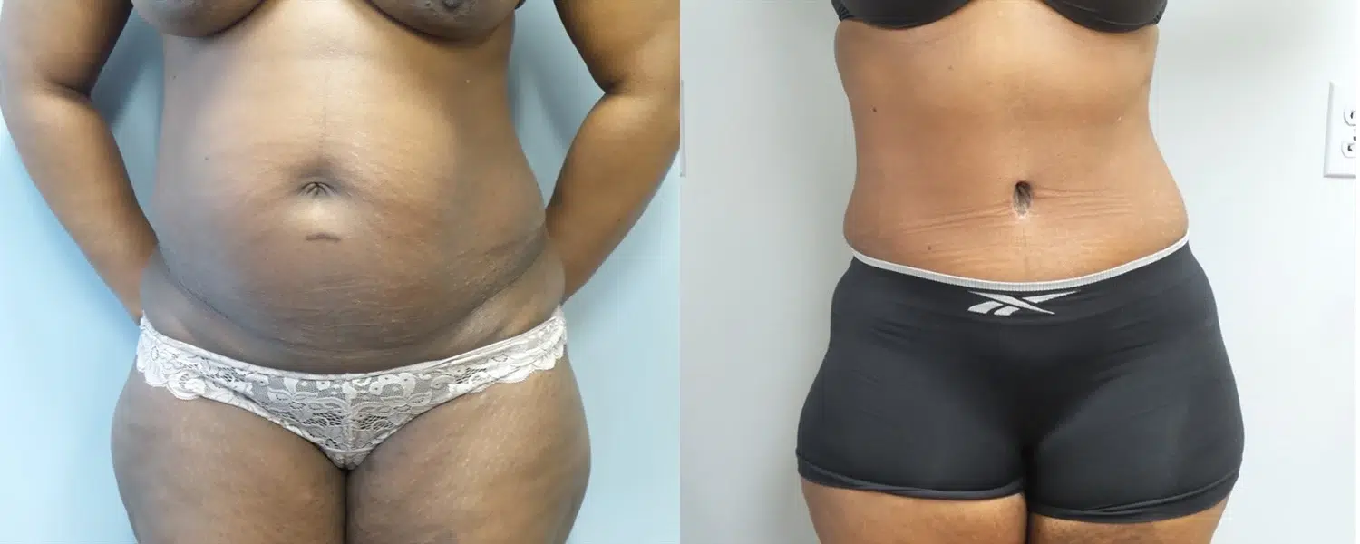 tummy tuck abdominoplasty before and after photo by main line institute of plastic surgery in wynnewood pa