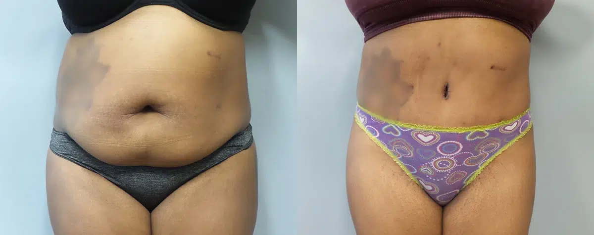 tummy tuck abdominoplasty before and after photo by main line institute of plastic surgery in wynnewood pa