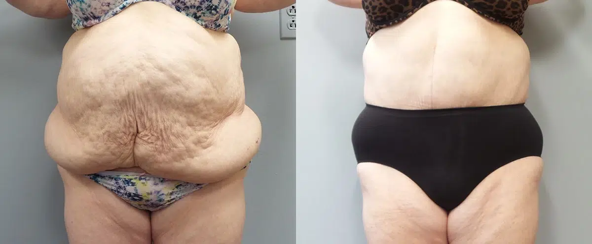 tummy tuck abdominoplasty before and after photo by main line institute of plastic surgery in wynnewood pa