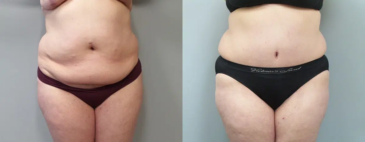 tummy tuck abdominoplasty before and after photo by main line institute of plastic surgery in wynnewood pa