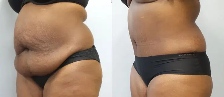 tummy tuck abdominoplasty before and after photo by main line institute of plastic surgery in wynnewood pa