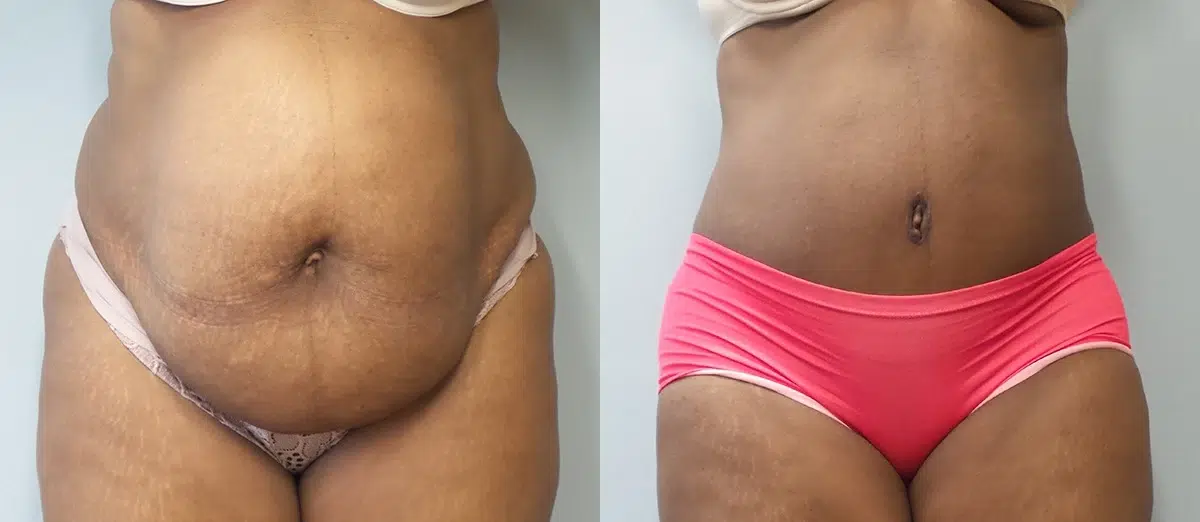 tummy tuck abdominoplasty before and after photo by main line institute of plastic surgery in wynnewood pa