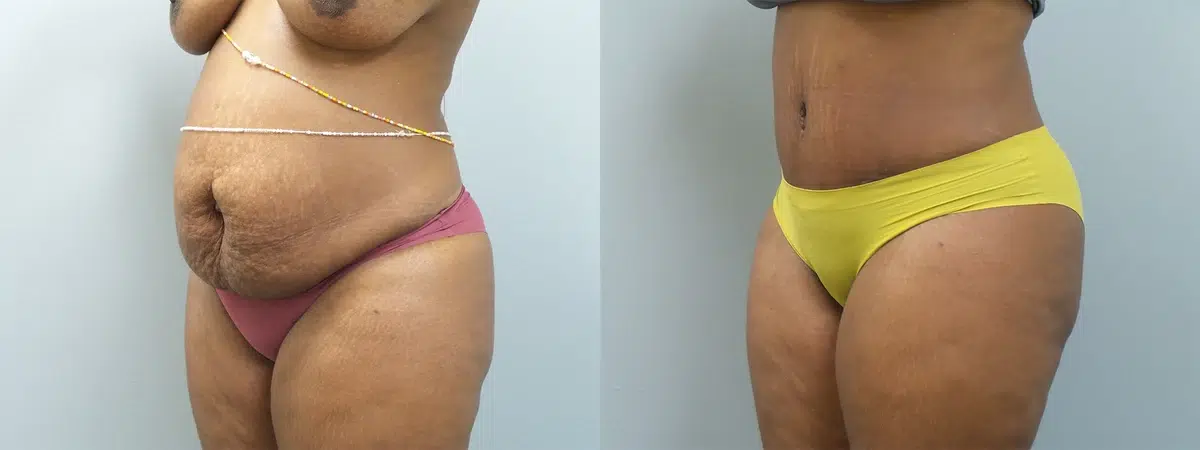 tummy tuck abdominoplasty before and after photo by main line institute of plastic surgery in wynnewood pa