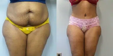 tummy tuck abdominoplasty before and after photo by main line institute of plastic surgery in wynnewood pa