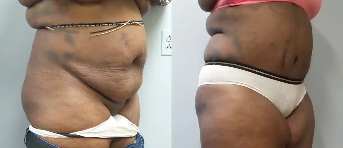 tummy tuck abdominoplasty before and after photo by main line institute of plastic surgery in wynnewood pa