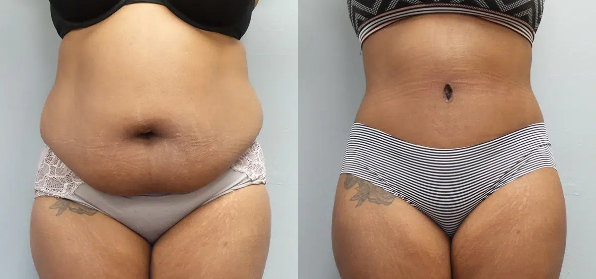 tummy tuck abdominoplasty before and after photo by main line institute of plastic surgery in wynnewood pa