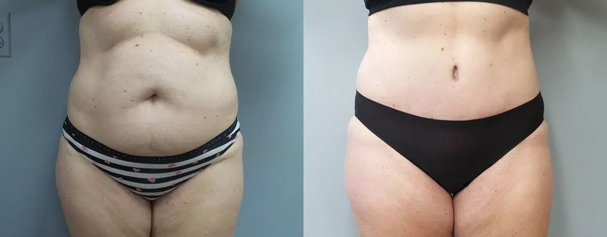 tummy tuck abdominoplasty before and after photo by main line institute of plastic surgery in wynnewood pa