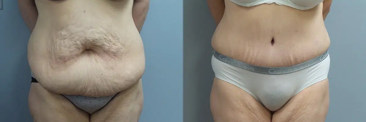 tummy tuck abdominoplasty before and after photo by main line institute of plastic surgery in wynnewood pa