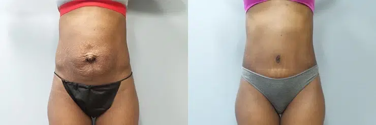 tummy tuck abdominoplasty before and after photo by main line institute of plastic surgery in wynnewood pa