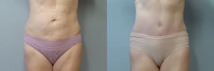 tummy tuck abdominoplasty before and after photo by main line institute of plastic surgery in wynnewood pa