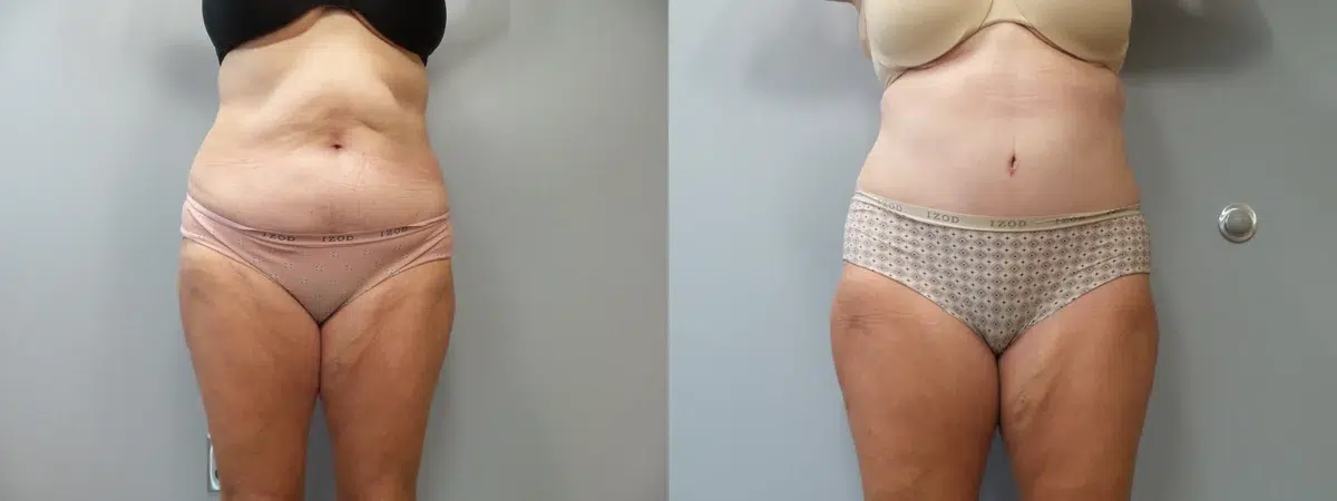 tummy tuck abdominoplasty before and after photo by main line institute of plastic surgery in wynnewood pa