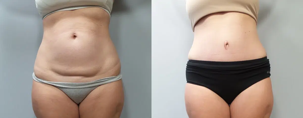 tummy tuck abdominoplasty before and after photo by main line institute of plastic surgery in wynnewood pa
