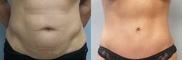 tummy tuck abdominoplasty before and after photo by main line institute of plastic surgery in wynnewood pa