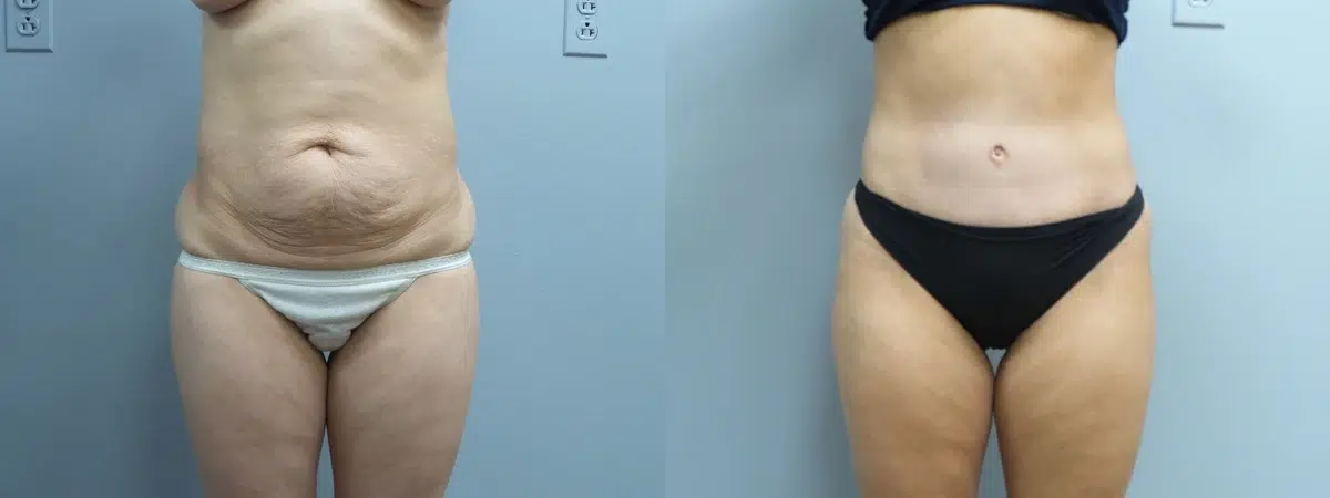 tummy tuck abdominoplasty before and after photo by main line institute of plastic surgery in wynnewood pa