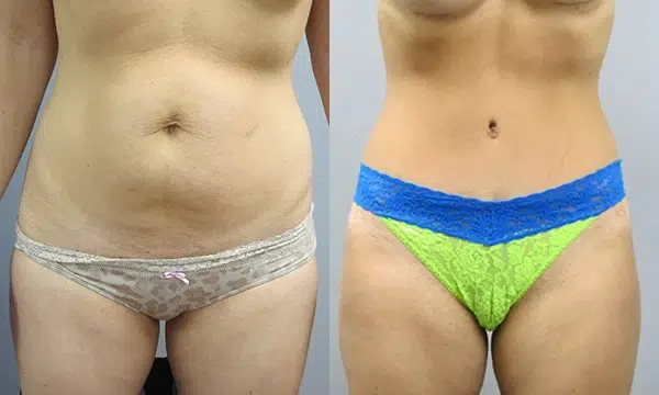 tummy tuck abdominoplasty before and after photo by main line institute of plastic surgery in wynnewood pa