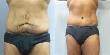 tummy tuck abdominoplasty before and after photo by main line institute of plastic surgery in wynnewood pa