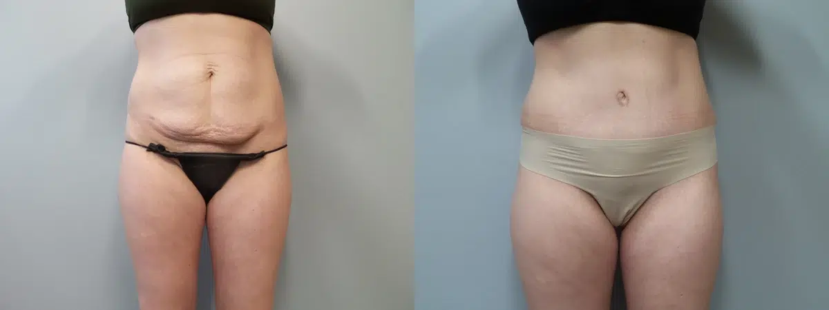 tummy tuck abdominoplasty before and after photo by main line institute of plastic surgery in wynnewood pa