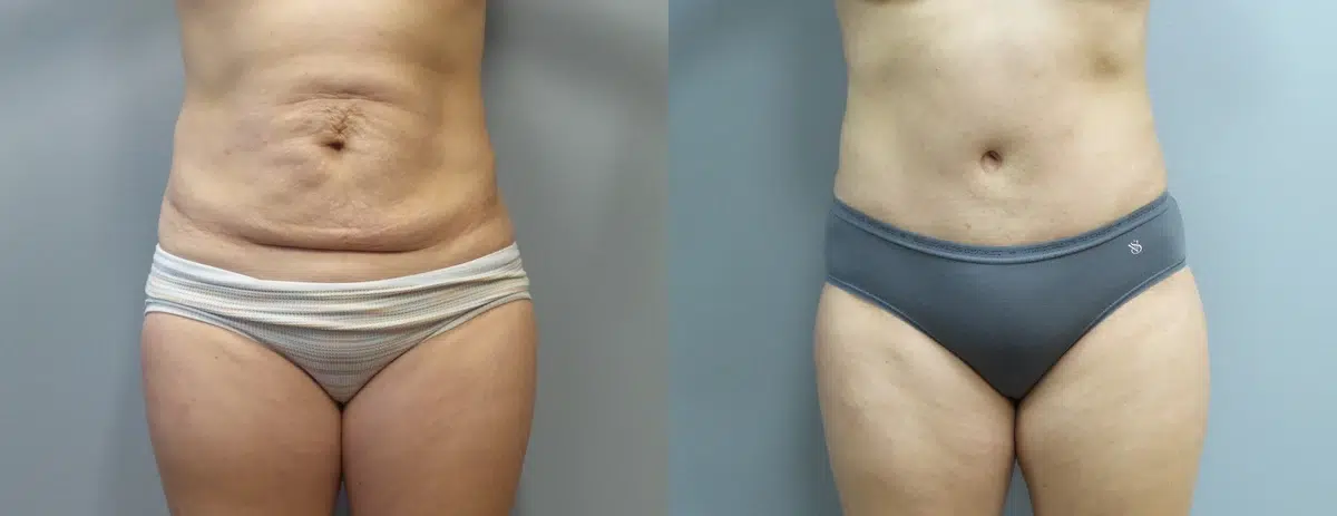 tummy tuck abdominoplasty before and after photo by main line institute of plastic surgery in wynnewood pa