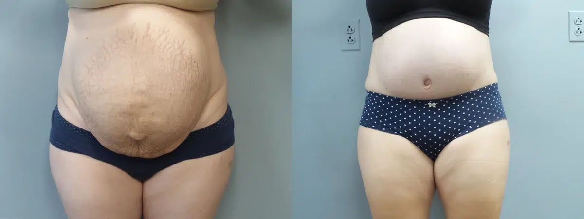 tummy tuck abdominoplasty before and after photo by main line institute of plastic surgery in wynnewood pa