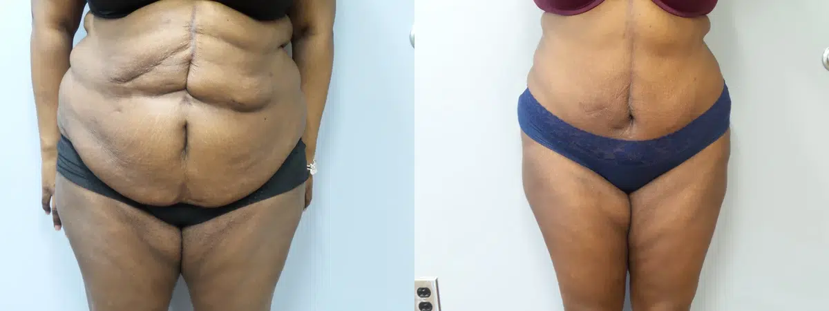 tummy tuck abdominoplasty before and after photo by main line institute of plastic surgery in wynnewood pa