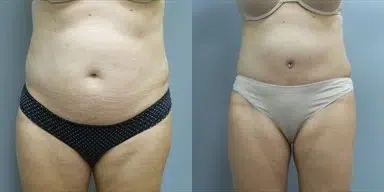 tummy tuck abdominoplasty before and after photo by main line institute of plastic surgery in wynnewood pa