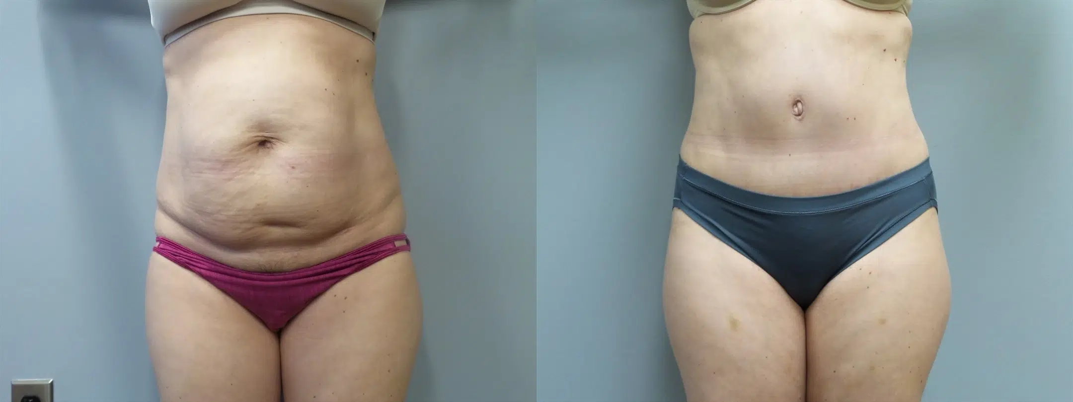tummy tuck abdominoplasty before and after photo by main line institute of plastic surgery in wynnewood pa